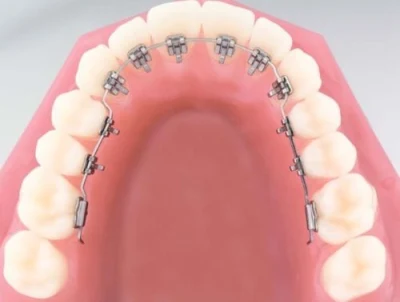 Staffe dentali linguali in metallo Prodotti ortodontici Bretelle per denti Mini Roth